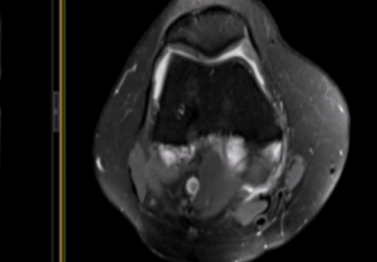 微創射頻消融術 微創射頻消融術